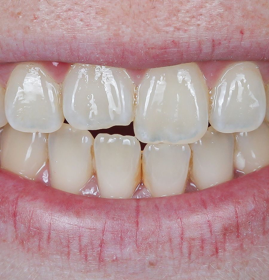 Chipped tooth repair Before